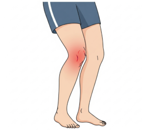 sintomas torção no joelho