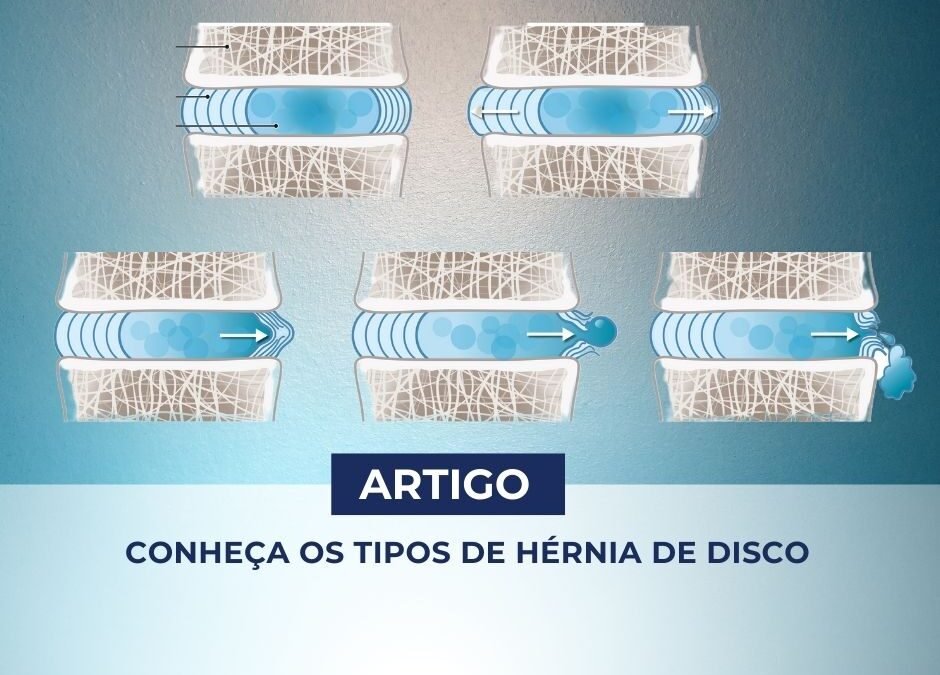 Conheça os Tipos de Hérnia de Disco