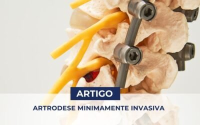 Artrodese Minimamente Invasiva da Coluna